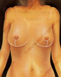 cost breast reduction surgery abroad