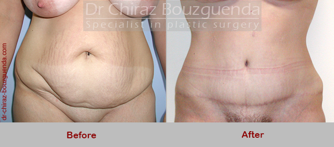 tummy tuck before after