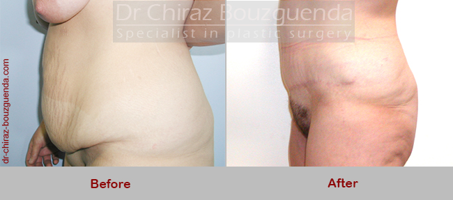 tummy tuck before after