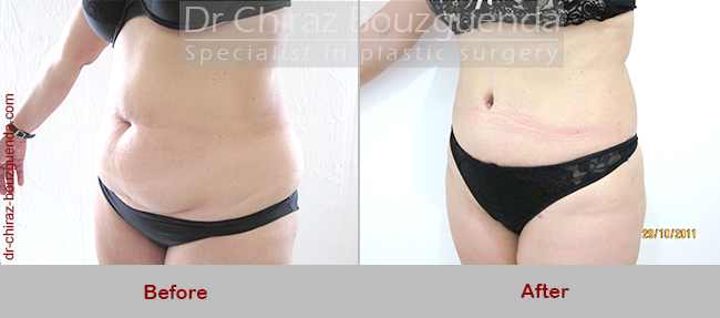 tummy tuck before after pictures