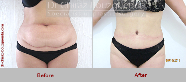 tummy tuck before after photos