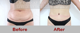 tummy tuck before after photos