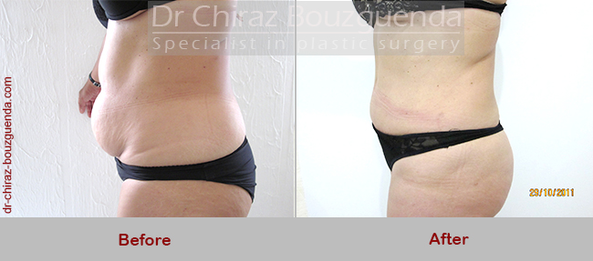 tummy tuck before after photos