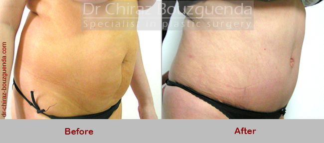 tummy tuck before after photos abroad