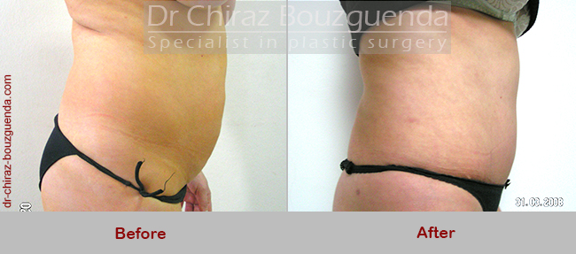 abdominoplasty before and after photos