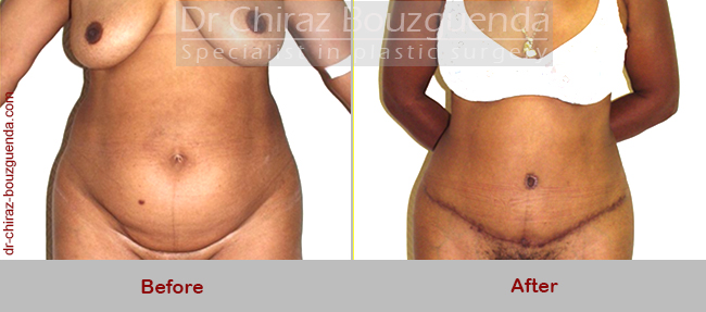 tummy tuck before after pics