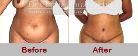 tummy tuck before after photos