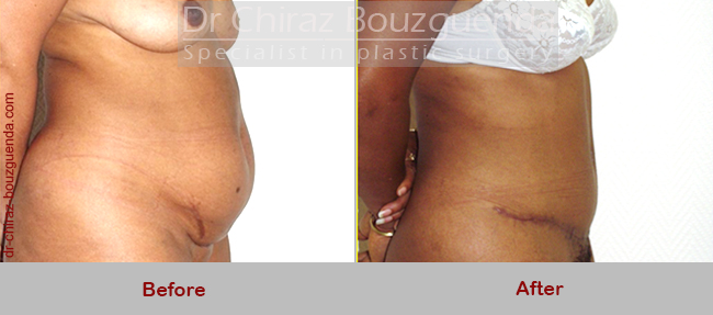 tummy tuck before after photos tunisia
