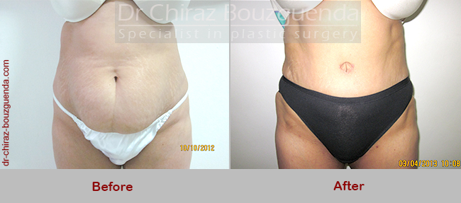 tummy tuck before after results