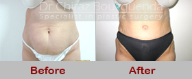 tummy tuck before after photos