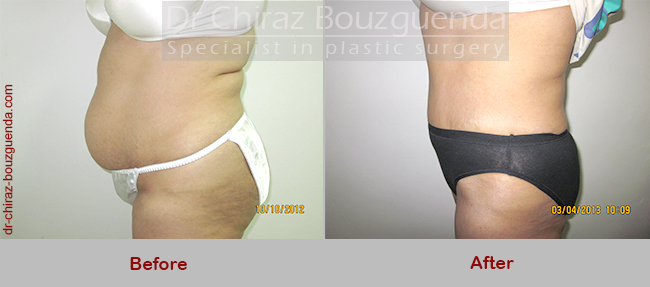 tummy tuck before after photos