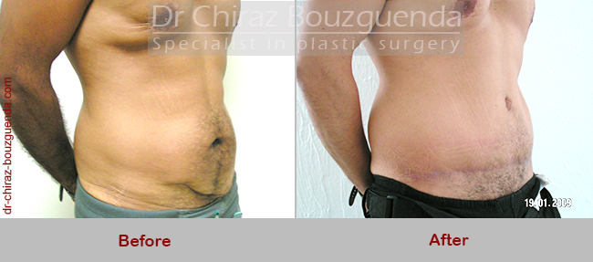 tummy tuck before after photos abroad