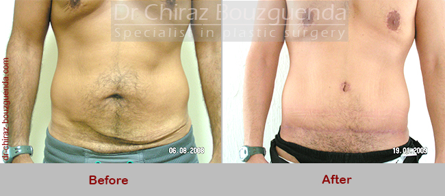 tummy tuck before after