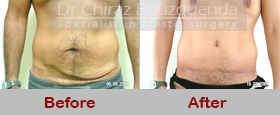 tummy tuck before after pictures