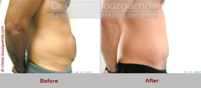 tummy tuck before after photos tunisia