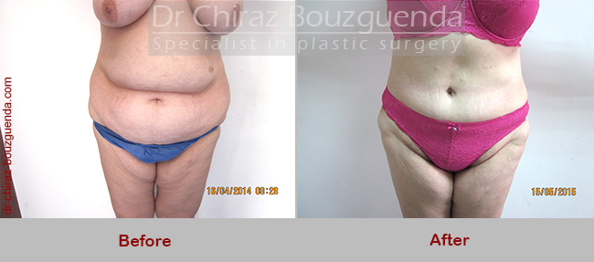 tummy tuck before after photos uk