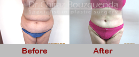 tummy tuck before after photos