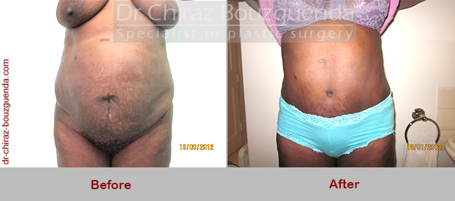 tummy tuck before after results tunisia