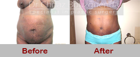 tummy tuck before after photos