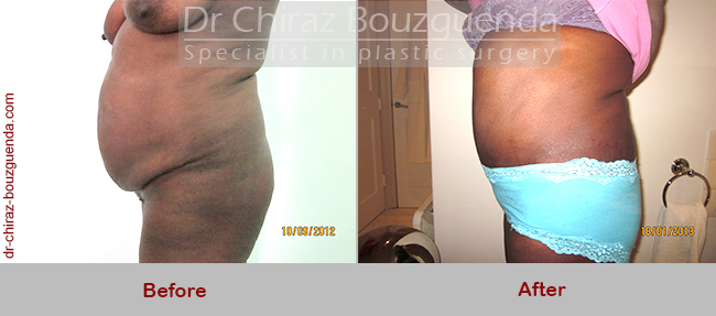 tummy tuck before after pics
