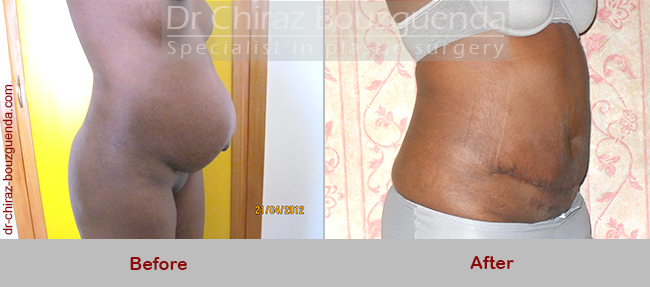 tummy tuck abroad before after photos