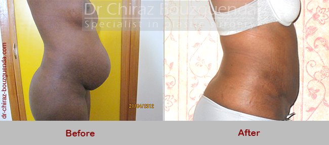 abdominoplasty abroad before after photos