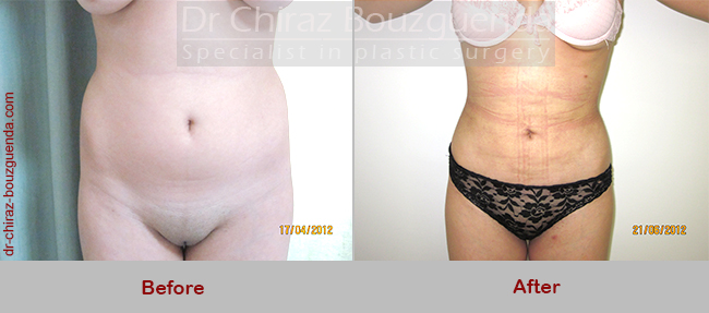 liposuction before after