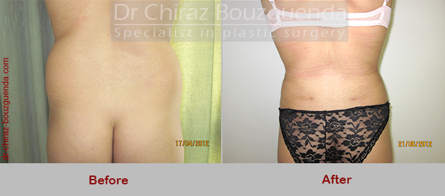 liposuction before after