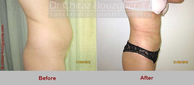 liposuction before after