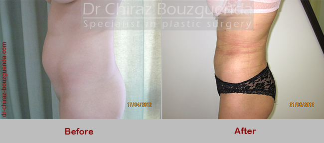 liposuction before after