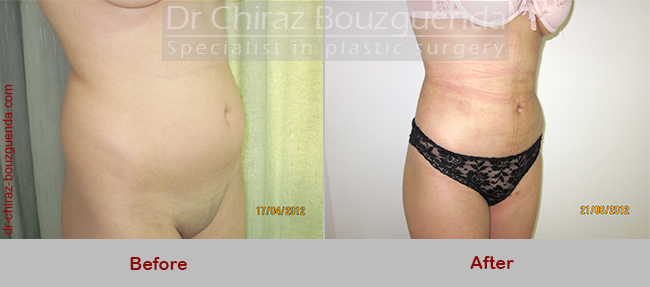 liposuction before after