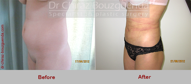 liposuction before after