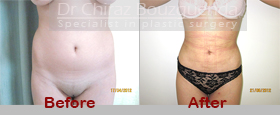 liposuction before after