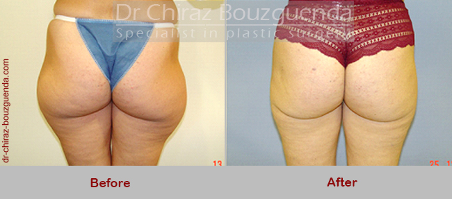 liposuction before after