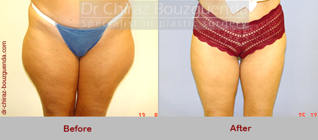 liposuction before after