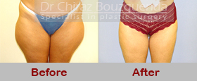 liposuction before after