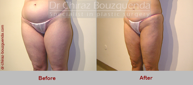 liposuction before after