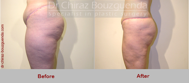 liposuction before after