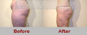 liposuction before after