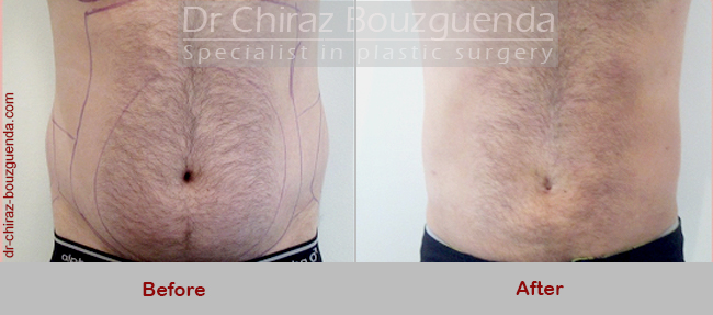 male liposuction before after