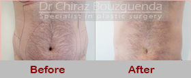 male liposuction before after