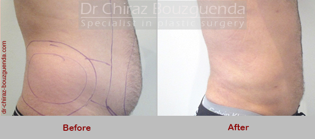 male liposuction before after