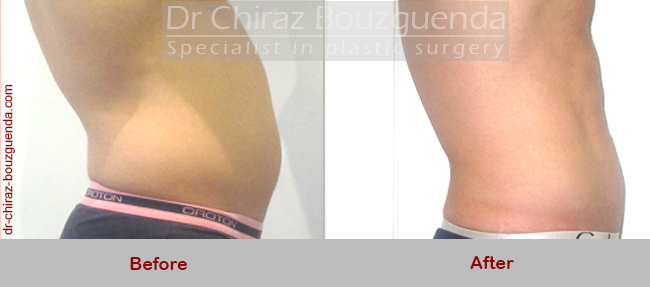 male liposuction before after