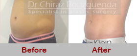 male liposuction before after