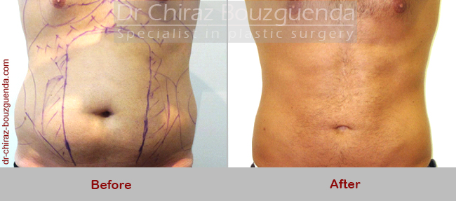 male liposuction before and after