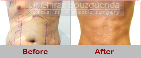 male liposuction before after