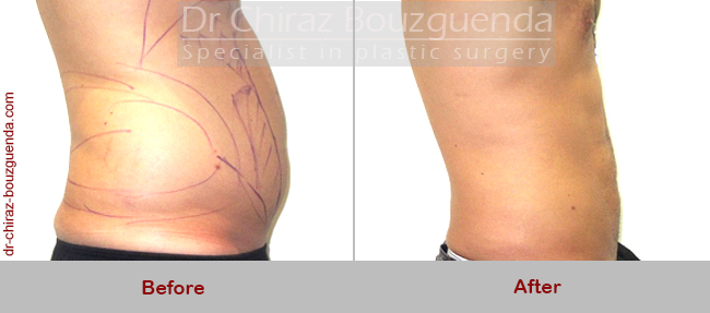 male liposuction before and after