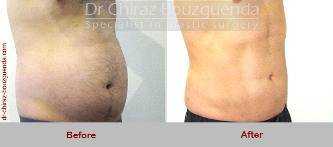 male liposuction before and after