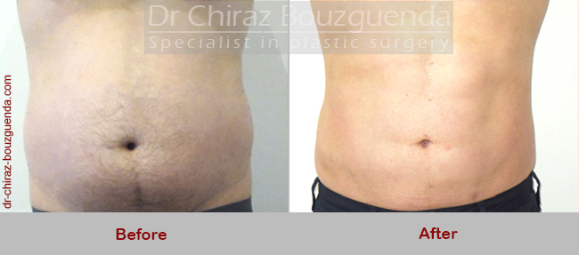 male liposuction before and after