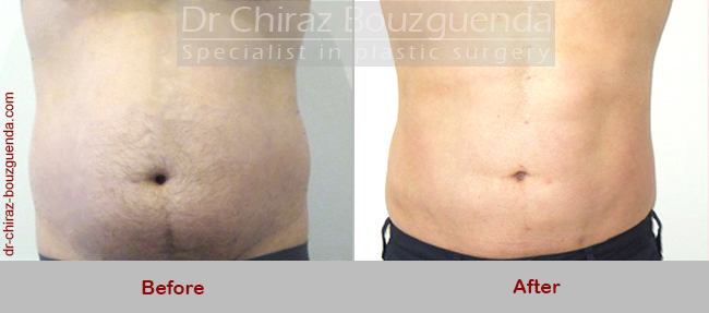 male liposuction before and after